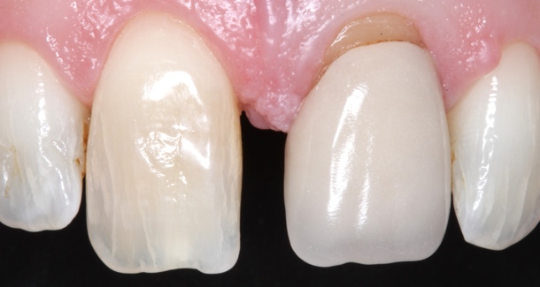 Indirect adhesive cementation with Maxcem Elite Chroma